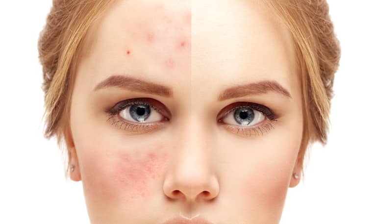 Heeft je klant last van rosacea? Dit is wat je moet weten...