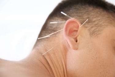 Man ondergaat een behandeling oor acupunctuur