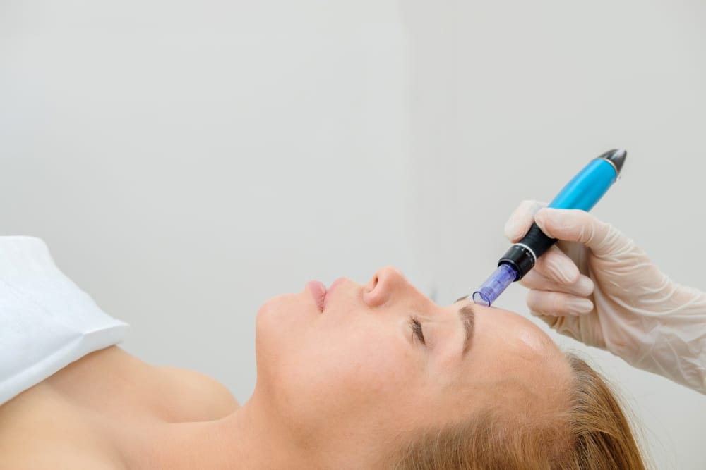 Waarop letten bij een microneedling behandeling?