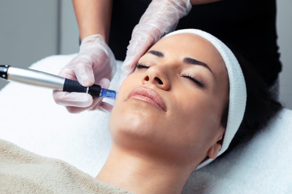 Hoe werkt microneedling nu juist?
