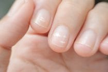 De oorzaken van witte vlekjes op je nagels.