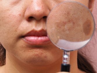 tips voor pigmentvlekjes verminderen.