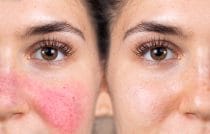 Behandelingen die echt werken bij rosacea.