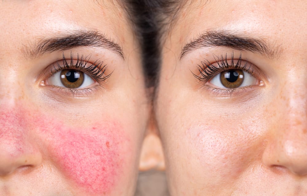 Rosacea: welke beauty behandelingen helpen echt?