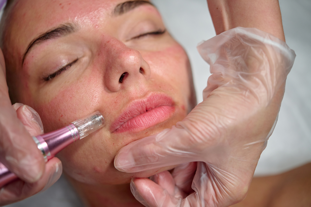 Do's & don'ts na microneedling